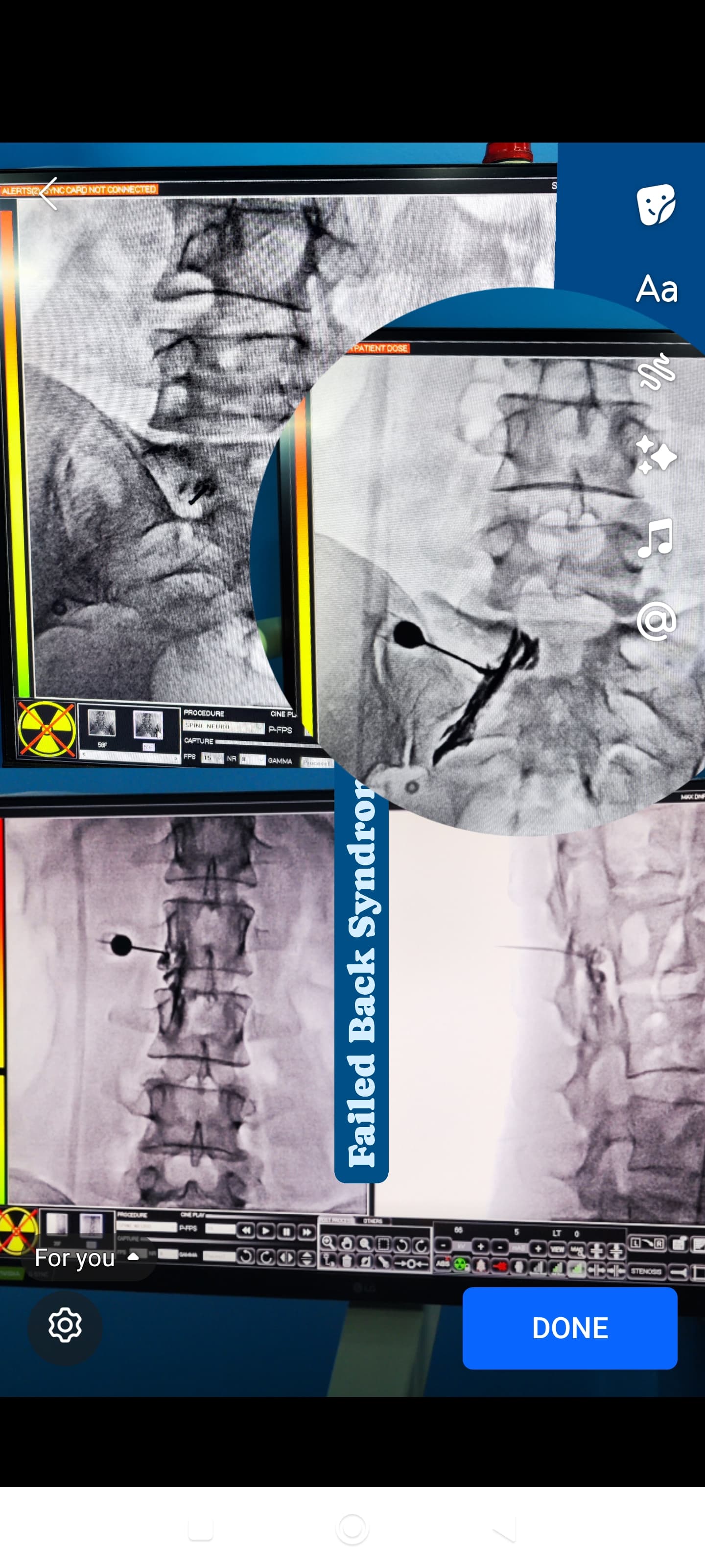 FBSS Failed Back Surgery Syndrome