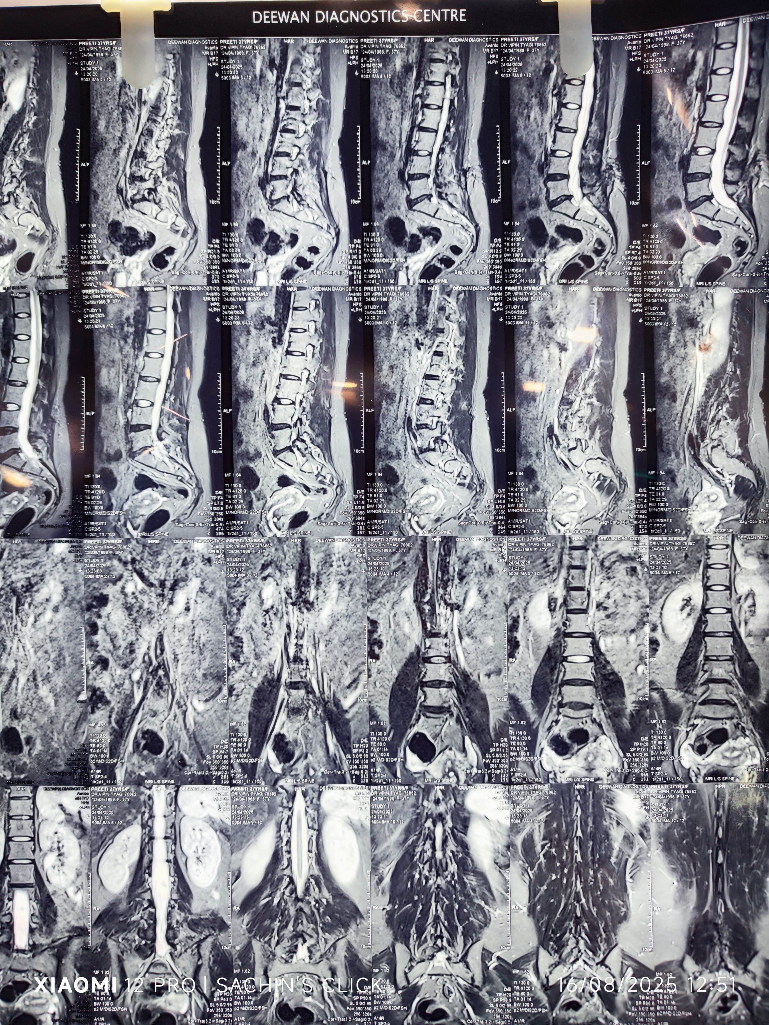 Multiple Spine slice